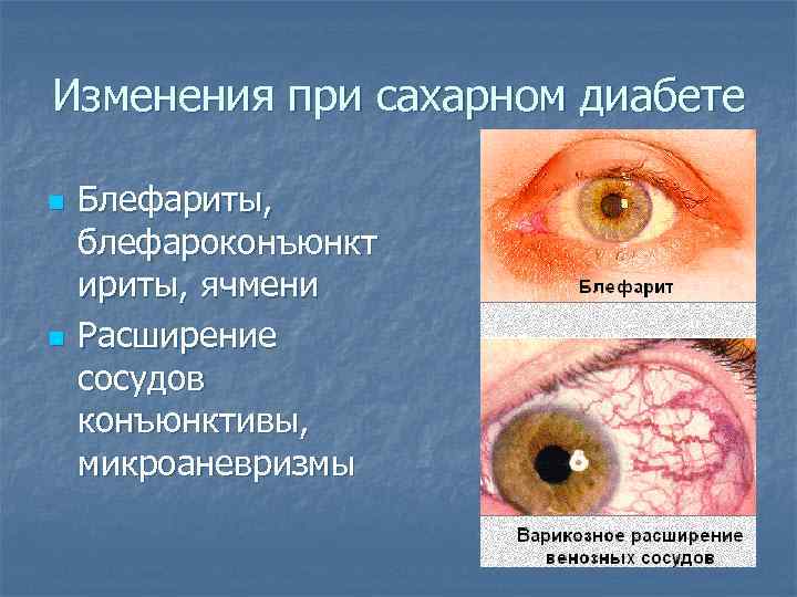 Изменения при сахарном диабете n n Блефариты, блефароконъюнкт ириты, ячмени Расширение сосудов конъюнктивы, микроаневризмы