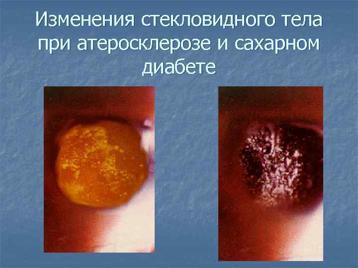 Изменения стекловидного тела при атеросклерозе и сахарном диабете 