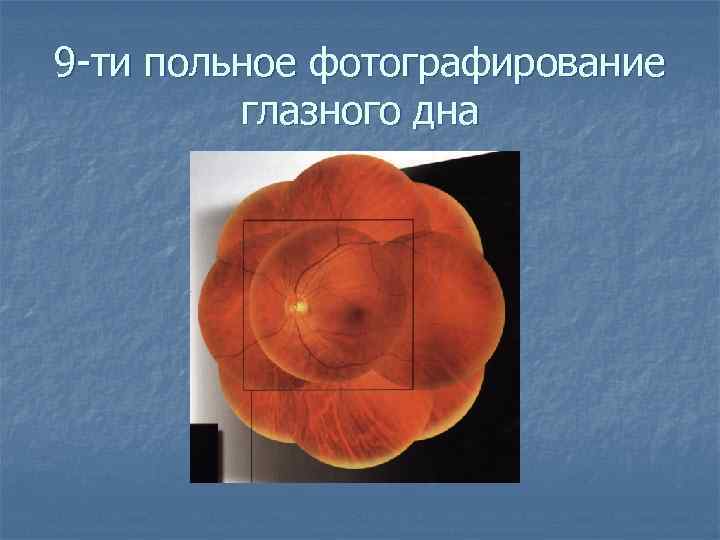 9 -ти польное фотографирование глазного дна 