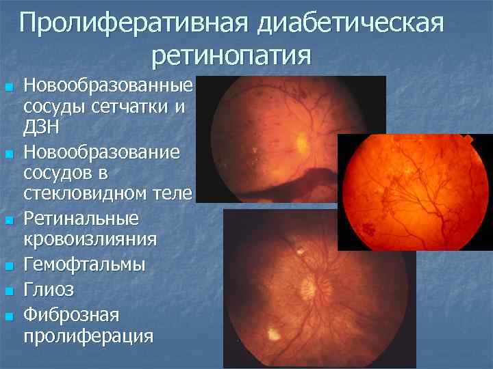 Пролиферативная диабетическая ретинопатия n n n Новообразованные сосуды сетчатки и ДЗН Новообразование сосудов в