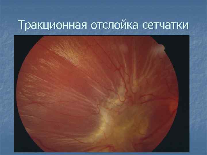 Тракционная отслойка сетчатки 
