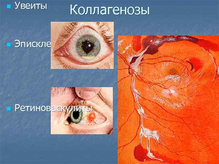 n Увеиты n Эписклериты n Ретиноваскулиты Коллагенозы 