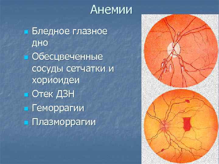 Изменение на глазном дне. Изменения глазного дна при анемии. Гемералопия глазное дно. Неоваскуляризация диска зрительного нерва. Глазное дно при анемии.