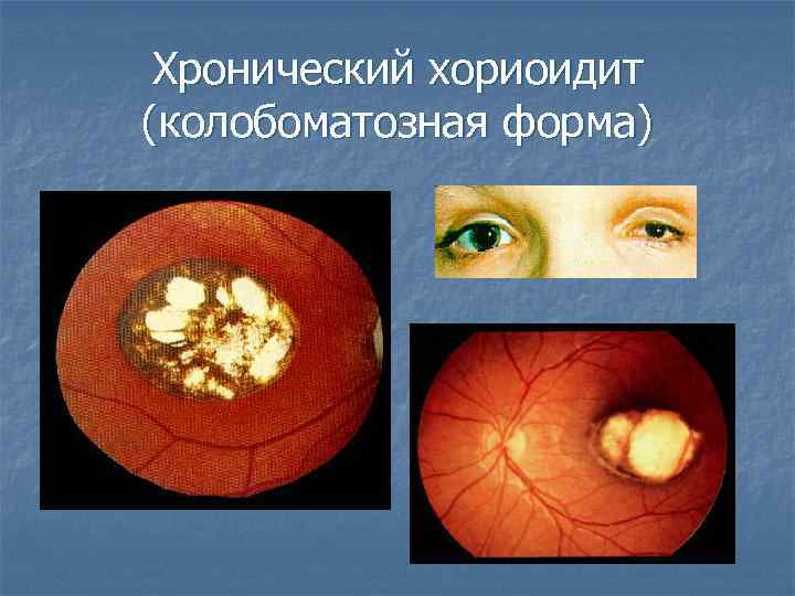Хронический хориоидит (колобоматозная форма) 
