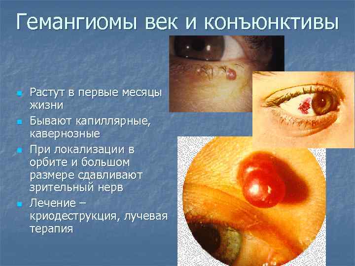 Гемангиомы век и конъюнктивы n n Растут в первые месяцы жизни Бывают капиллярные, кавернозные
