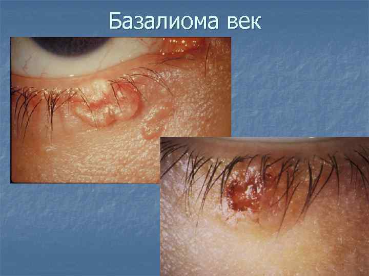 Базалиома век 