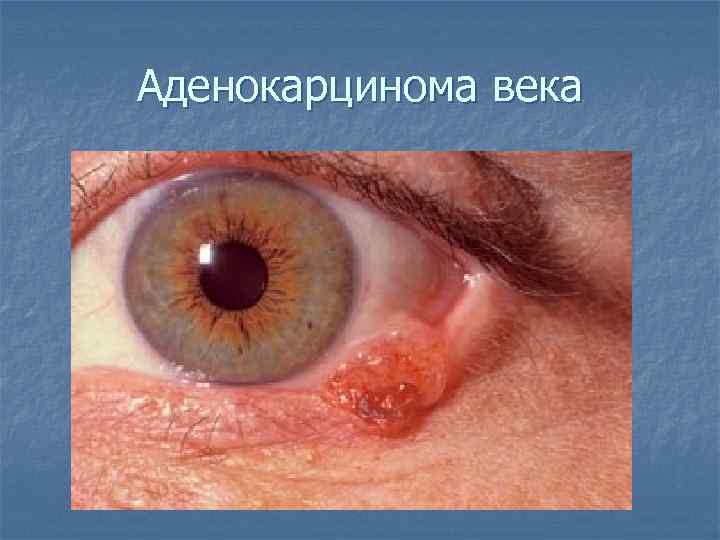 Аденокарцинома века 