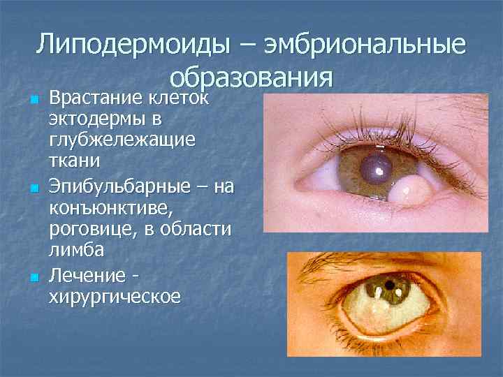 Липодермоиды – эмбриональные образования n n n Врастание клеток эктодермы в глубжележащие ткани Эпибульбарные