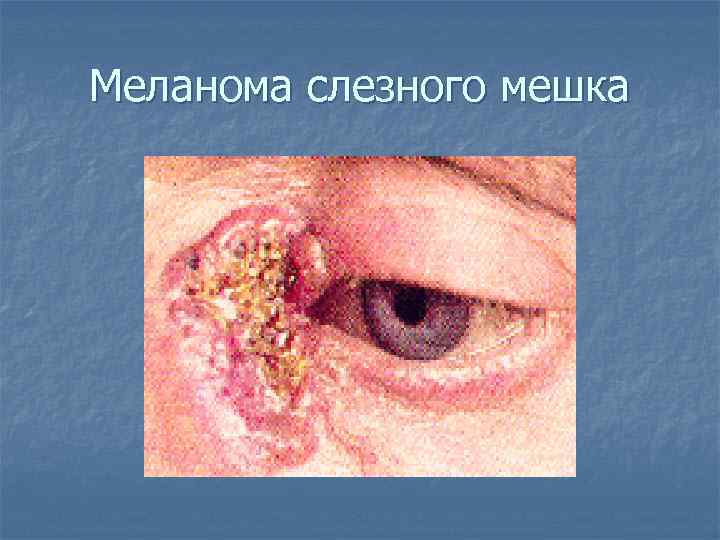 Меланома слезного мешка 
