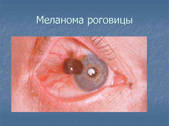 Меланома роговицы 