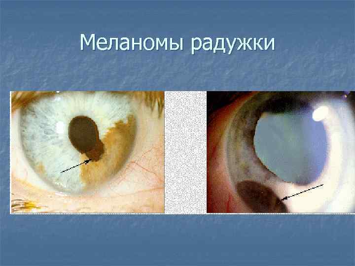 Меланомы радужки 