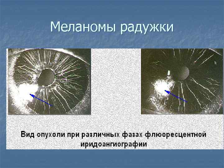Меланомы радужки 