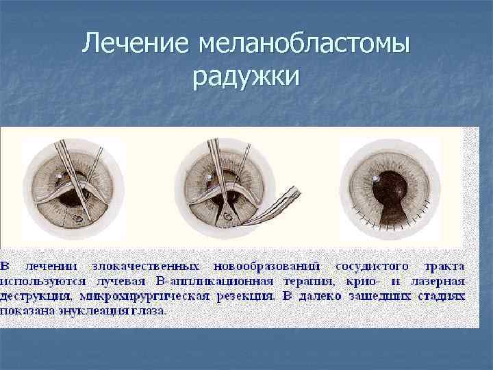 Лечение меланобластомы радужки 
