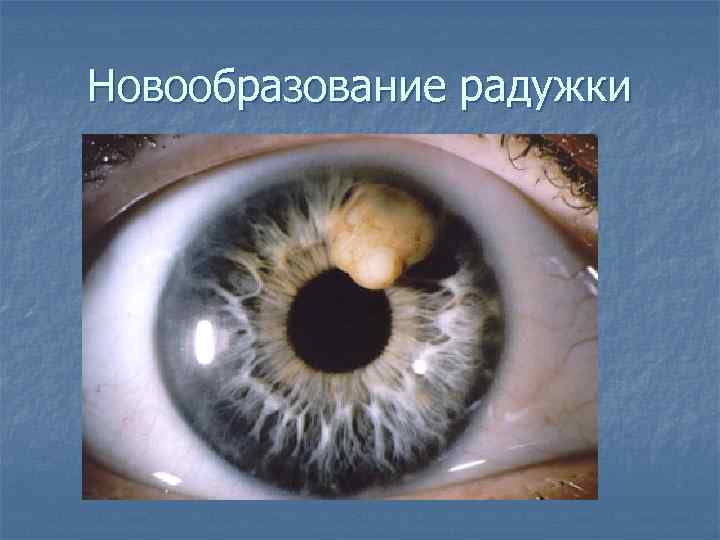 Новообразование радужки 