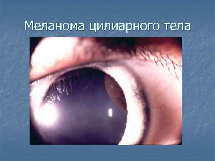 Меланома цилиарного тела 