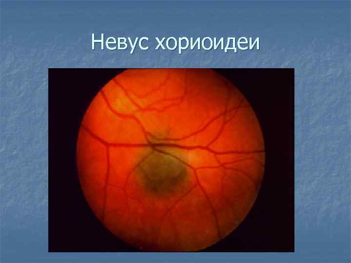 Невус хориоидеи 