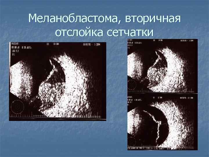 Меланобластома, вторичная отслойка сетчатки 