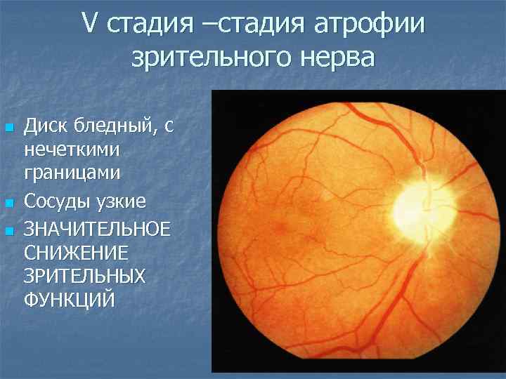 Диск зрительного нерва. Застойный диск зрительного нерва стадии. Застойный диск зрительного нерва 1 степени. Стушеванность границ диска зрительного нерва. Первичная атрофия зрительного нерва экскавация ДЗН.