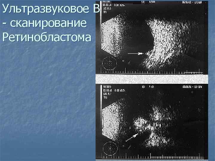 Ультразвуковое В - сканирование Ретинобластома 