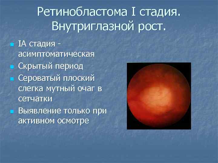 Ретинобластома I стадия. Внутриглазной рост. n n IА стадия асимптоматическая Скрытый период Сероватый плоский