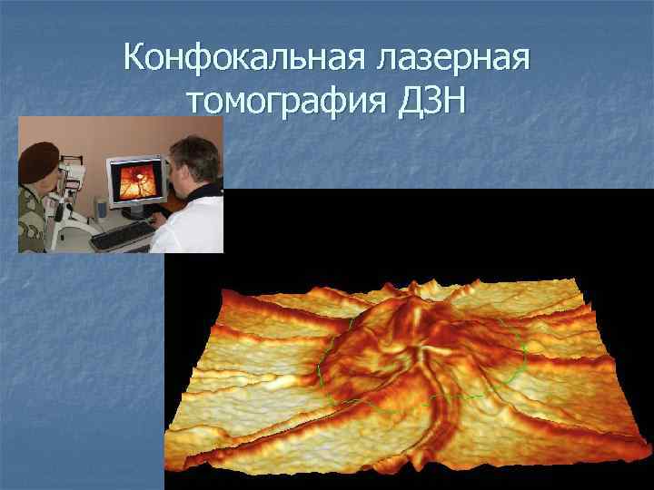 Конфокальная лазерная томография ДЗН 