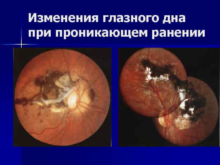 Изменения глазного дна при проникающем ранении 