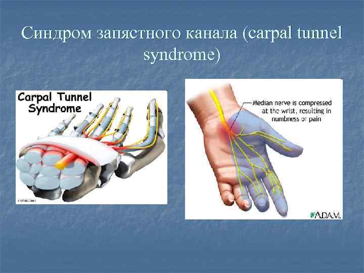 Синдром запястного канала (carpal tunnel syndrome) 