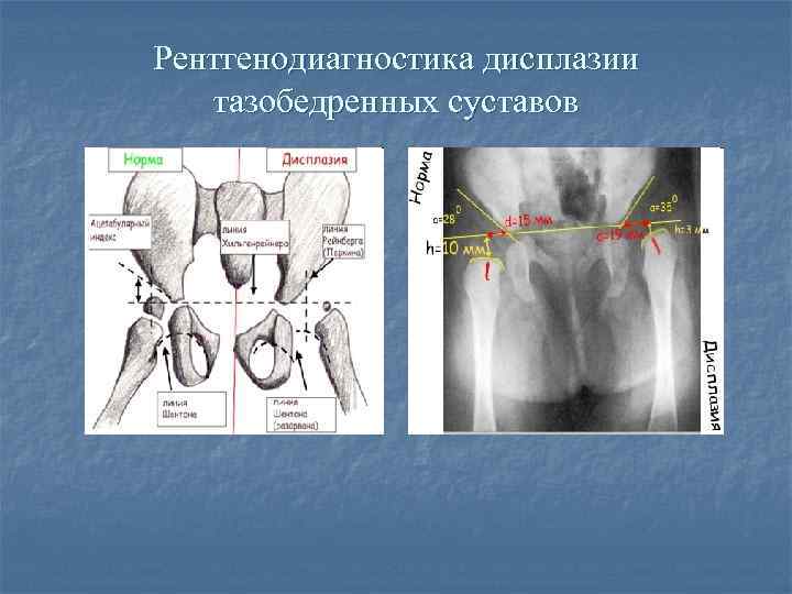 Рентгенодиагностика дисплазии тазобедренных суставов 