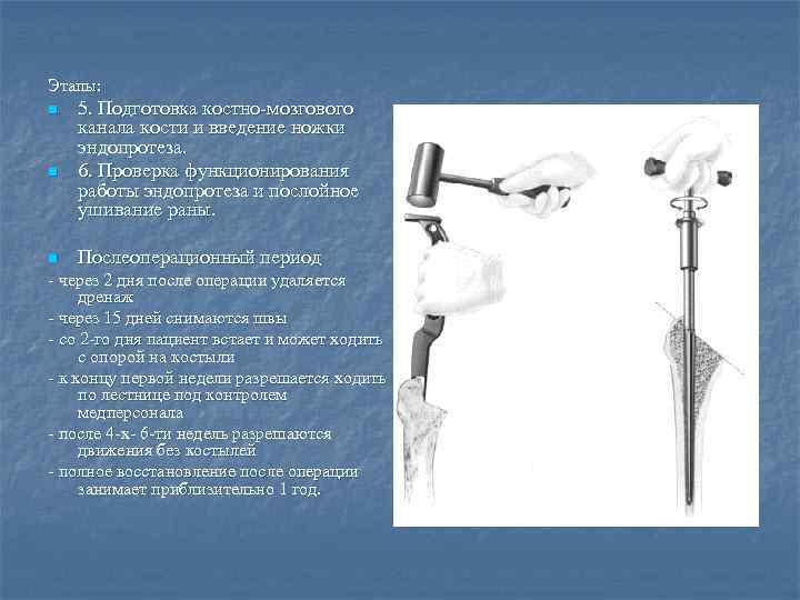 Этапы: n n n 5. Подготовка костно-мозгового канала кости и введение ножки эндопротеза. 6.
