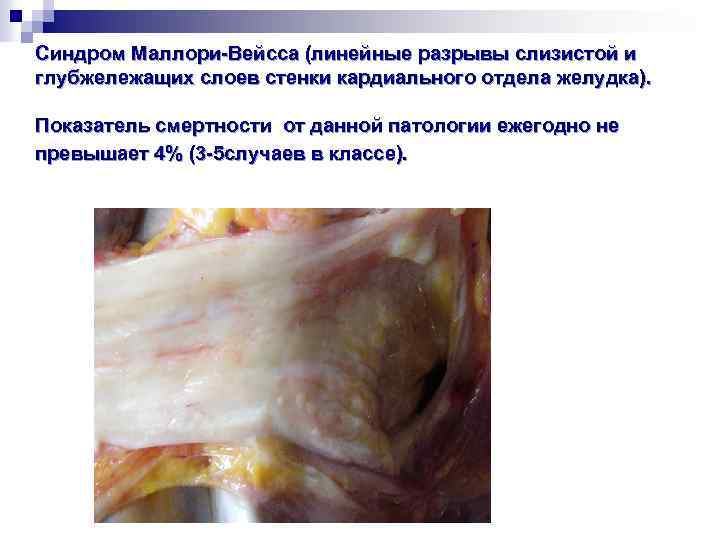 Синдром Маллори-Вейсса (линейные разрывы слизистой и глубжележащих слоев стенки кардиального отдела желудка). Показатель смертности