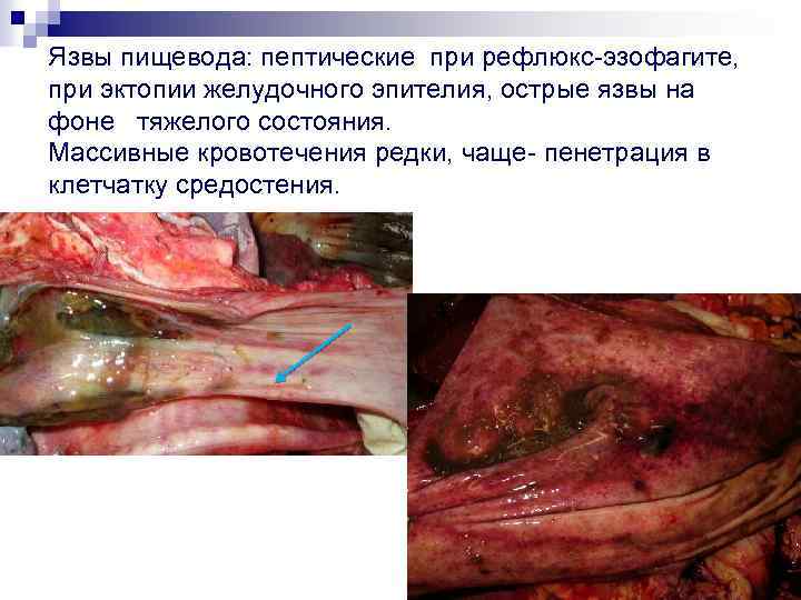 Язвы пищевода: пептические при рефлюкс-эзофагите, при эктопии желудочного эпителия, острые язвы на фоне тяжелого