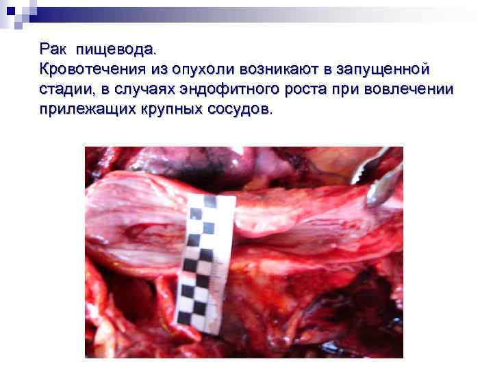 Рак пищевода. Кровотечения из опухоли возникают в запущенной стадии, в случаях эндофитного роста при