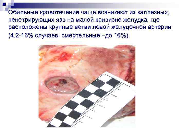 Обильные кровотечения чаще возникают из каллезных, пенетрирующих язв на малой кривизне желудка, где расположены