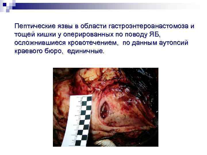 Пептические язвы в области гастроэнтероанастомоза и тощей кишки у оперированных по поводу ЯБ, осложнившиеся