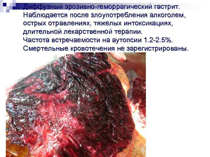 Диффузный эрозивно-геморрагический гастрит. Наблюдается после злоупотребления алкоголем, острых отравлениях, тяжелых интоксикациях, длительной лекарственной терапии.