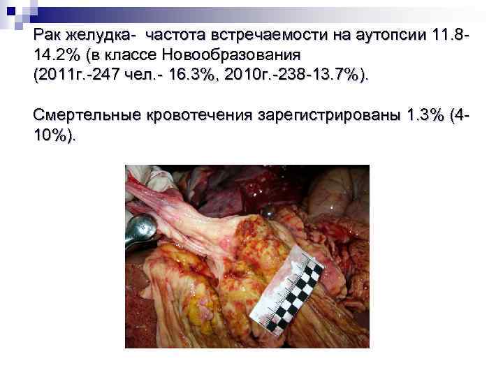 Рак желудка- частота встречаемости на аутопсии 11. 814. 2% (в классе Новообразования (2011 г.