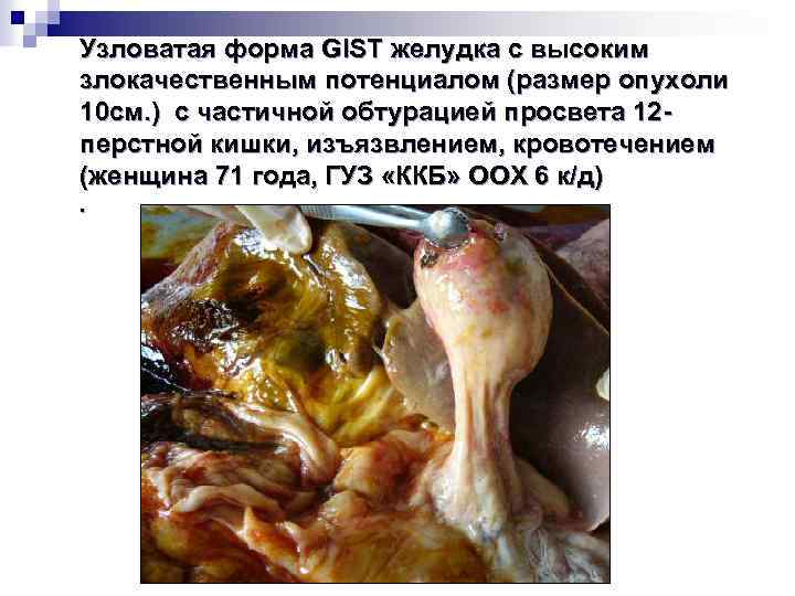 Узловатая форма GIST желудка с высоким злокачественным потенциалом (размер опухоли 10 см. ) с