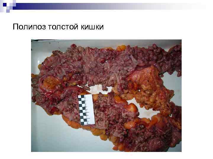 Полипоз толстой кишки 