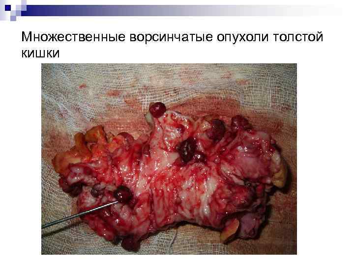 Множественные ворсинчатые опухоли толстой кишки 