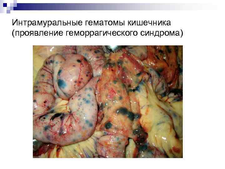 Интрамуральные гематомы кишечника (проявление геморрагического синдрома) 