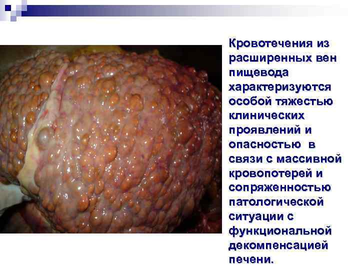 Кровотечения из расширенных вен пищевода характеризуются особой тяжестью клинических проявлений и опасностью в связи