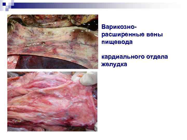 Варикознорасширенные вены пищевода кардиального отдела желудка 