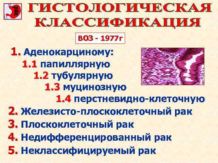 ВОЗ - 1977 г 1. Аденокарциному: 1. 1 папиллярную 1. 2 тубулярную 1. 3