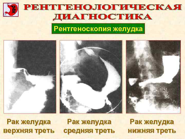 Рентгеноскопия желудка Рак желудка верхняя треть Рак желудка средняя треть Рак желудка нижняя треть