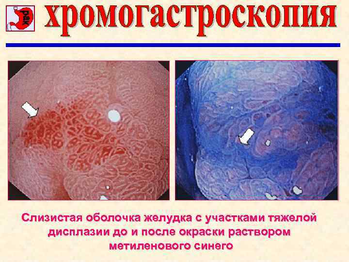 Слизистая оболочка желудка с участками тяжелой дисплазии до и после окраски раствором метиленового синего