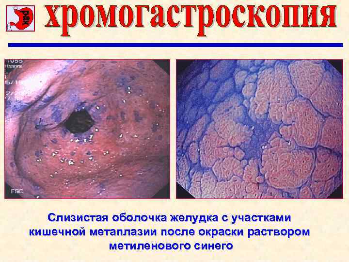 Слизистая оболочка желудка с участками кишечной метаплазии после окраски раствором метиленового синего 