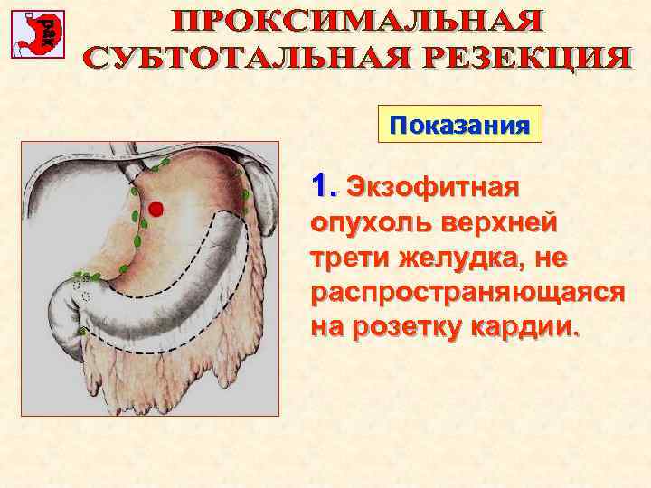 Показания 1. Экзофитная опухоль верхней трети желудка, не распространяющаяся на розетку кардии. 