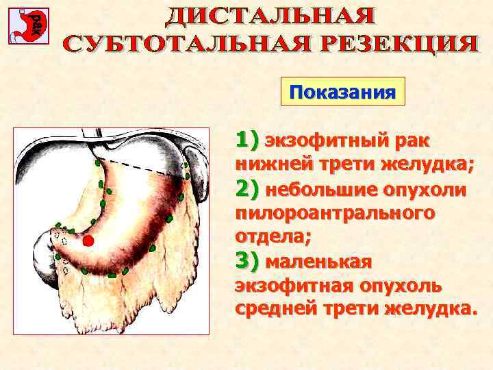 Показания 1) экзофитный рак нижней трети желудка; 2) небольшие опухоли пилороантрального отдела; 3) маленькая