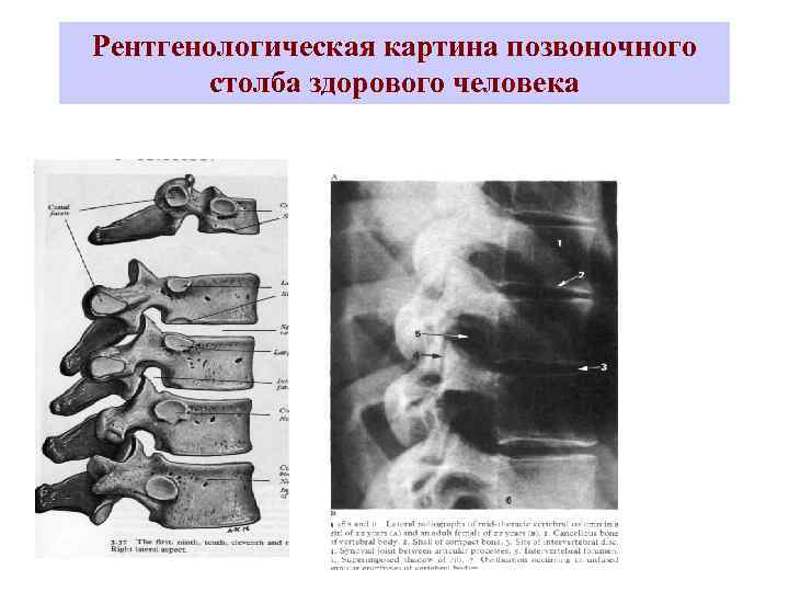 Рентгенологическая картина позвоночного столба здорового человека 