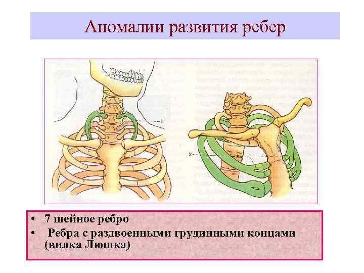 Аномалии развития ребер • 7 шейное ребро • Ребра с раздвоенными грудинными концами (вилка